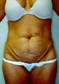Tummy tuck