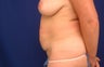 Tummy tuck