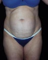 Tummy tuck