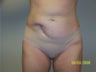 Tummy tuck