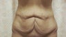 Tummy tuck