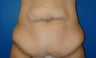 Tummy tuck