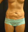 Tummy tuck