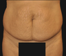 Tummy tuck