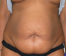 Tummy tuck