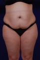 Tummy tuck