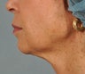 Ultherapy
