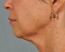 Ultherapy