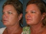 Ultherapy