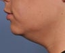 Ultherapy