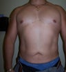 Vaser Liposuction