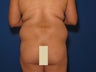 Vaser Liposuction