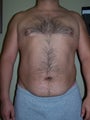 Vaser Liposuction