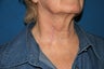 Tethered Neck Scar Revision