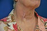 Tethered Neck Scar Revision