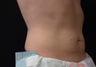 Coolsculpting Male