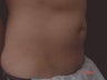 Coolsculpting Male