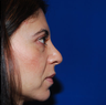 Revision Rhinoplasty