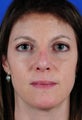 Revision Rhinoplasty