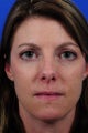 Revision Rhinoplasty