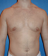 Gynecomastia