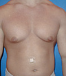 Gynecomastia