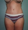 39 year old female patient 