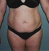 39 year old female patient 