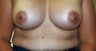 Breast Augmentation