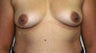 Breast Augmentation