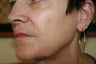 Sculptra