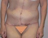 This 53 year old woman wanted to have a Body Lift 