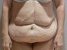 This 53 year old woman wanted to have a Body Lift 