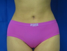 Liposuction