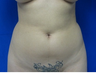 Liposuction