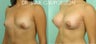 Breast Augmentation