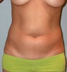 This 28 year old woman had difficult to control areas. 