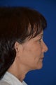 Ultherapy to cheeks and neck