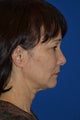 Ultherapy to cheeks and neck