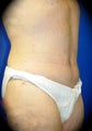 Post-Bariatric Surgery
