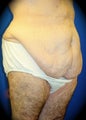 Post-Bariatric Surgery