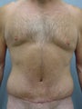 47 year old Male Tummy Tuck