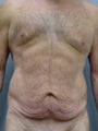 47 year old Male Tummy Tuck