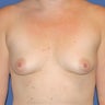 Breast augmentation with silicone implants