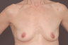 Breast Augmentation