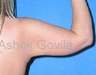 Arm Lift