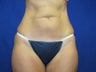 57 year old female had Liposonix treatment to abdomen and flanks