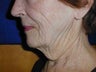 80 year old necklift