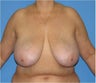 Breast Reduction