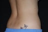 CoolSculpting Treatment of Abdomen